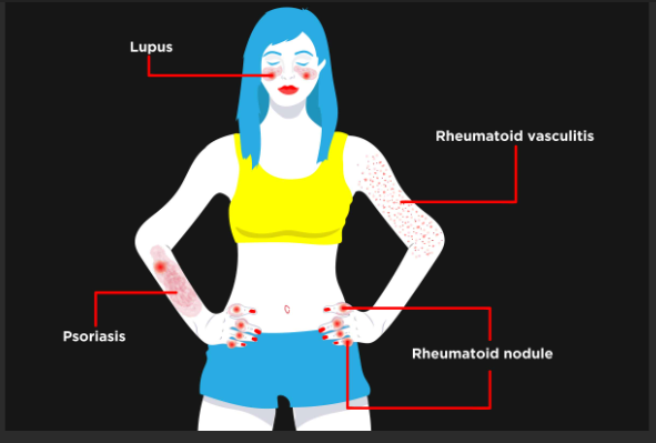 Lupus Psoriasis Vasculitis Rheumatoid Nodule