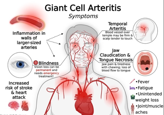 Giant Cell Arteritis